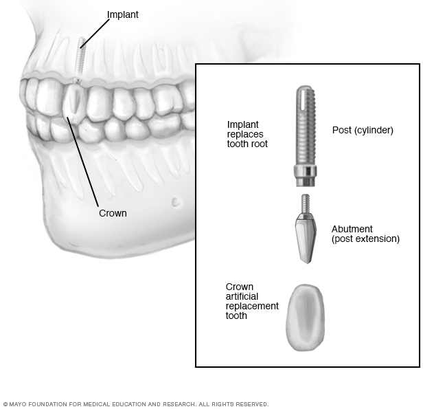 Dental implant surgery