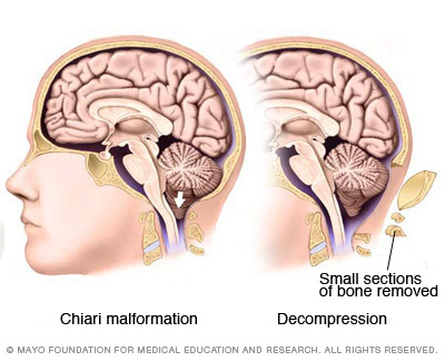 Malformación de Chiari