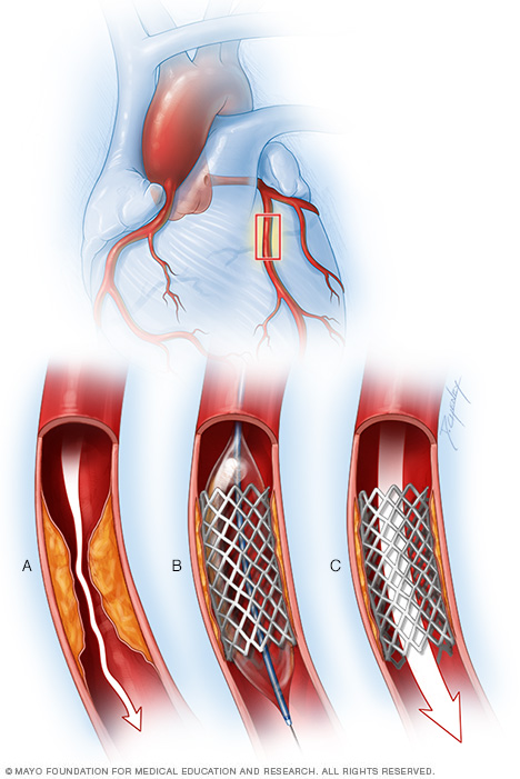 Coronary artery stent