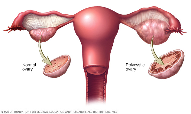 Sindrome De Ovario Poliquistico Middlesex Health