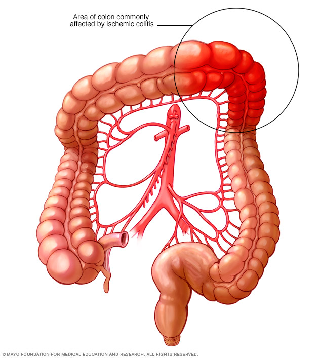 Dónde se presenta la colitis isquémica