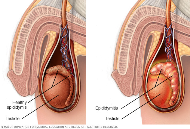 Scrotum, testicle and epididymis