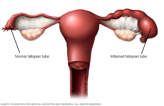 Illustration of pelvic inflammatory disease inflamed fallopian tube 
