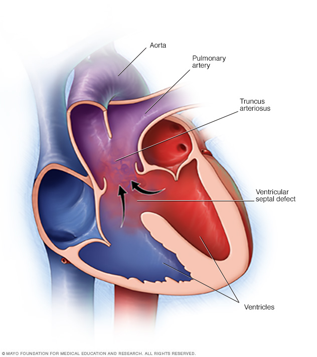 Tronco arterial