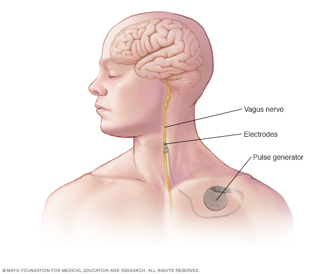 Generador de pulsos para la estimulación del nervio vago