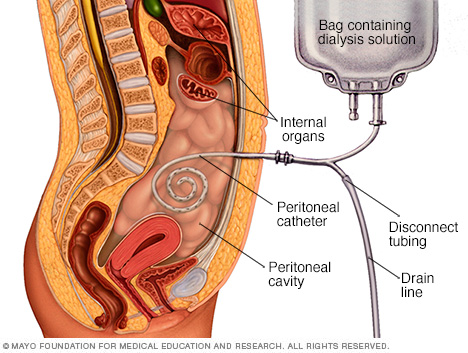 Imagen que muestra c&oacute;mo se realiza la di&aacute;lisis peritoneal