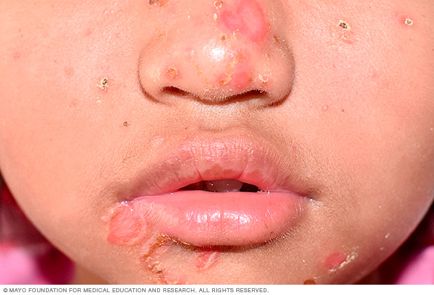 Impetigo sores 