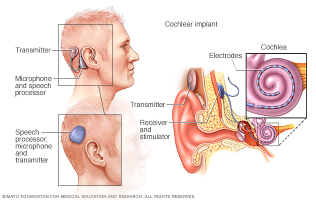 Cochlear implants