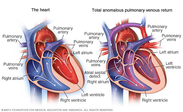 Retorno venoso pulmonar anómalo total