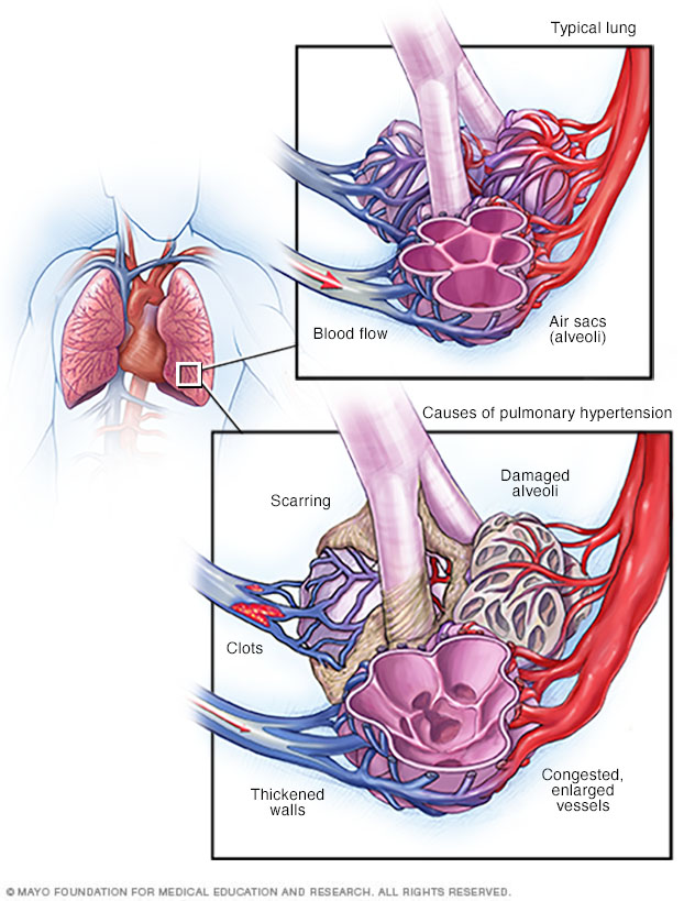 Exercise and PH - Pulmonary Hypertension Association