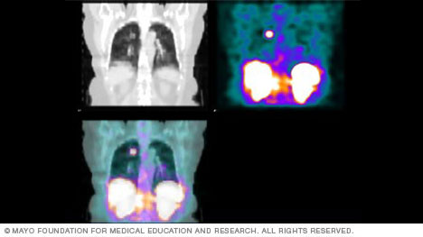 SPECT scan results picture