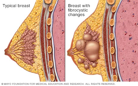 Typical breast tissue and a breast with fibrocystic changes