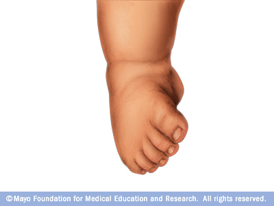 Clubfoot Middlesex Health