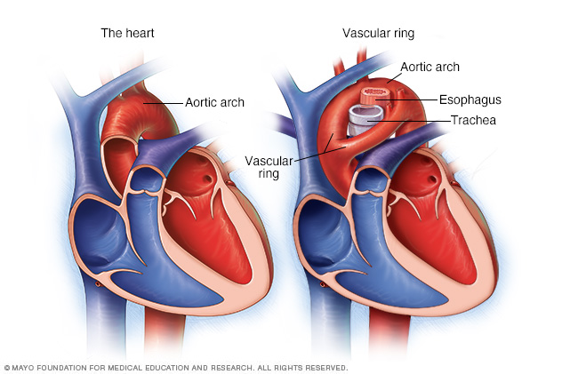 Anillo vascular