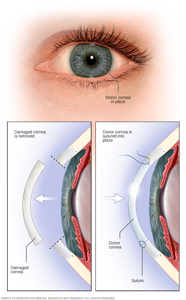 Cornea transplant 