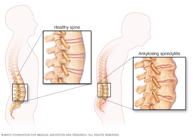 Cambios de la columna vertebral en la espondilitis anquilosante