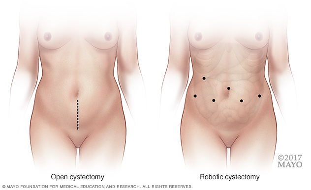 Where incisions are made in open versus robotic cystectomy
