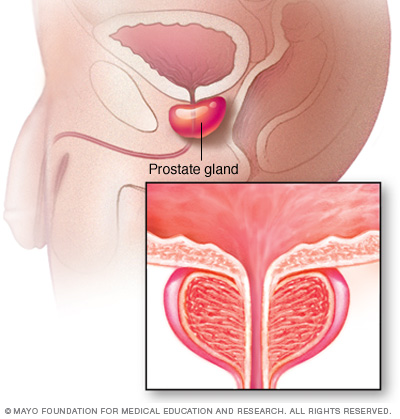 termoterapie pentru prostatită tratamentul prostatitei cu turmeric