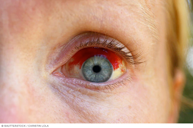 Imagen de un vaso sanguíneo roto en el ojo