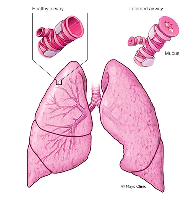 What happens during an asthma attack