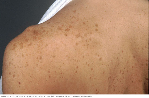 Age spots on the shoulder and back