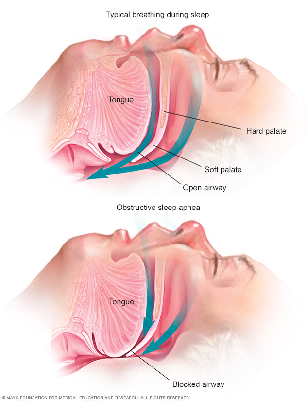 Sleep apnea in women: New research could lead to better diagnosis and  treatment