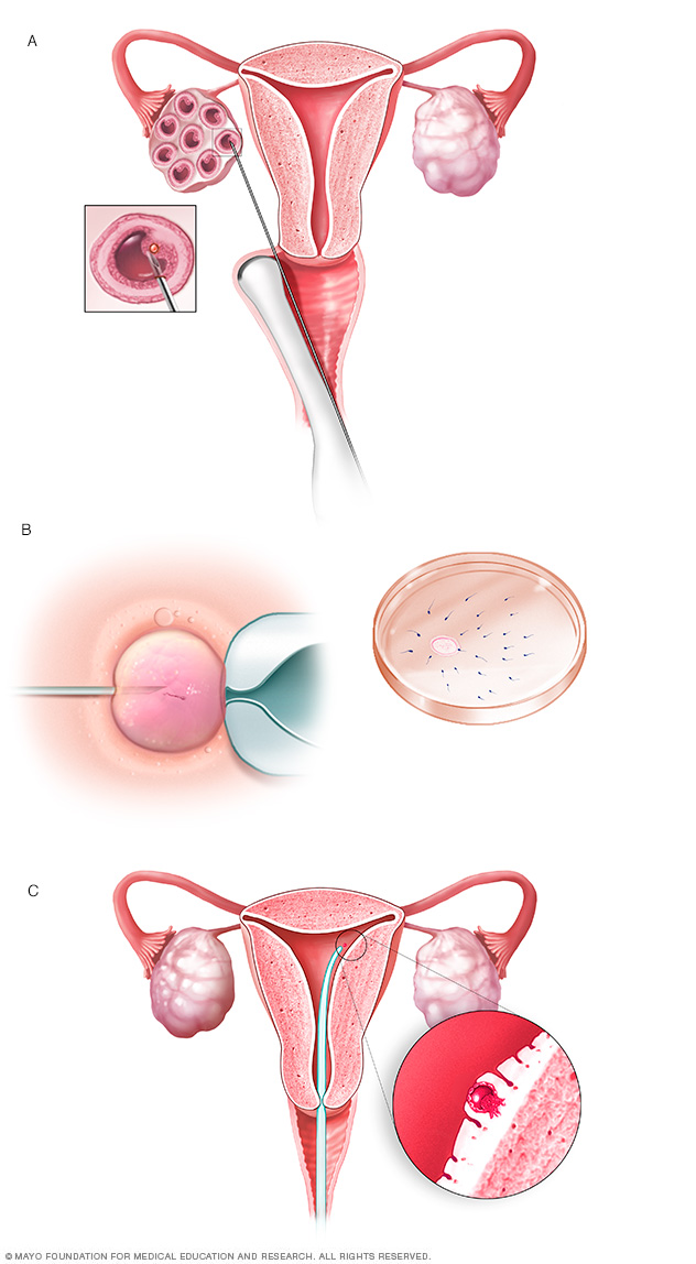 Proceso de fertilización in vitro