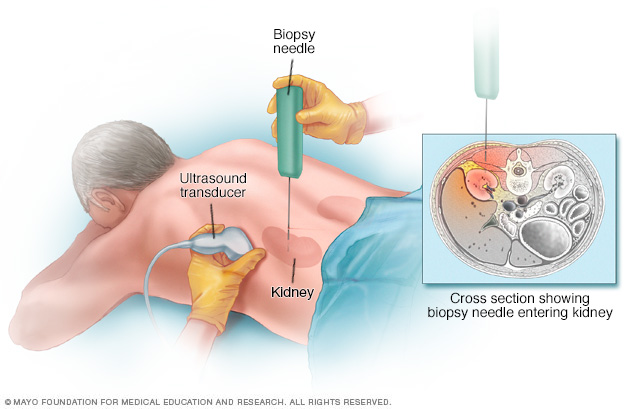 Kidney biopsy