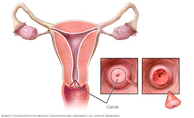 Cone biopsy