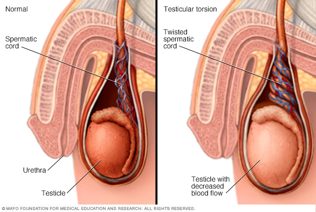 Ilustración de un pene antes y durante la torsión testicular