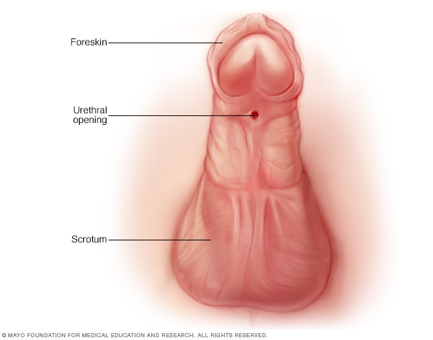 Image showing hypospadias 
