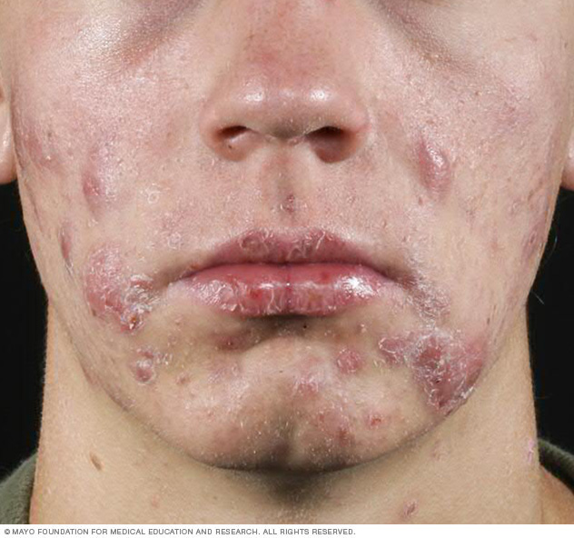 Cystic acne