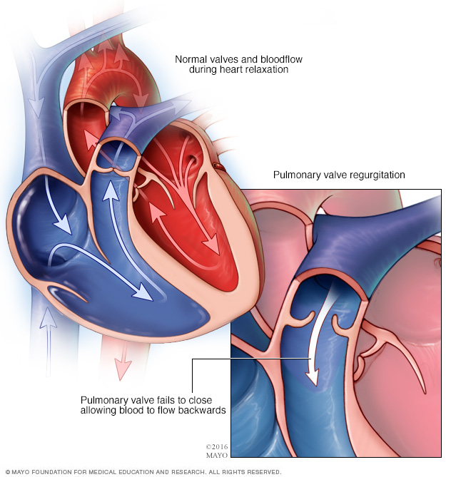 Pulmonary valve regurgitation