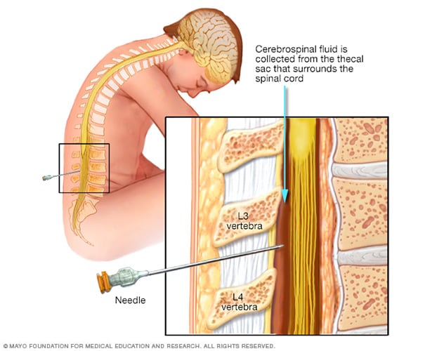 Lumbar puncture, also known as a spinal tap