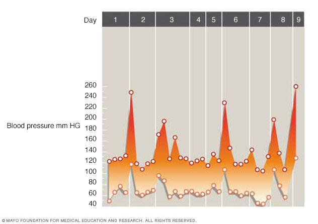 Gráfico que muestra fluctuaciones de la presión arterial provocadas por feocromocitoma