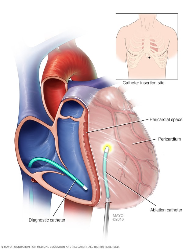 Heart during epicardial ablation