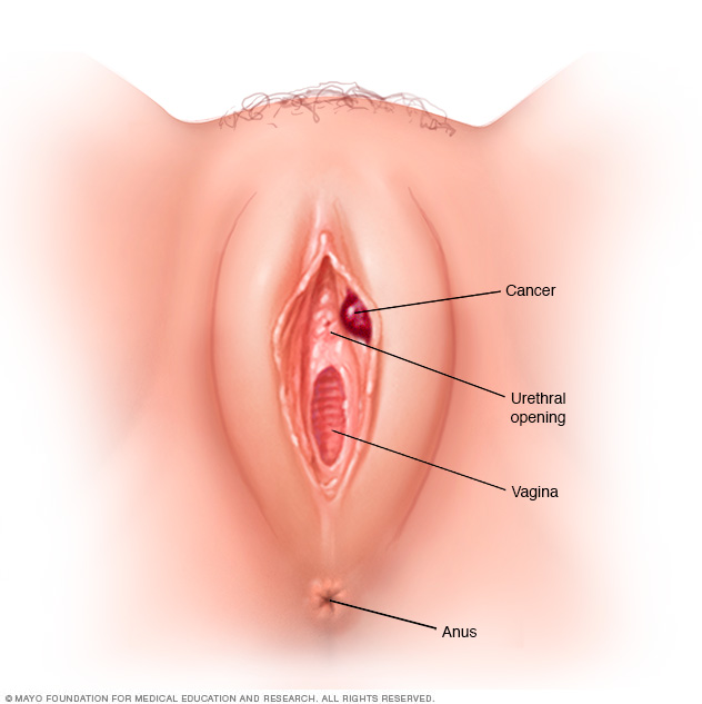 Vulvar cancer // Middlesex Health