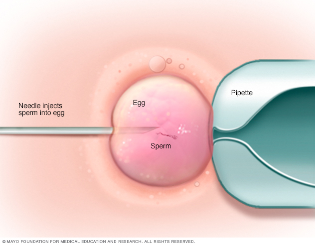 Inyección intracitoplásmica de espermatozoides