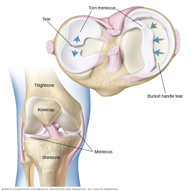 Torn meniscus