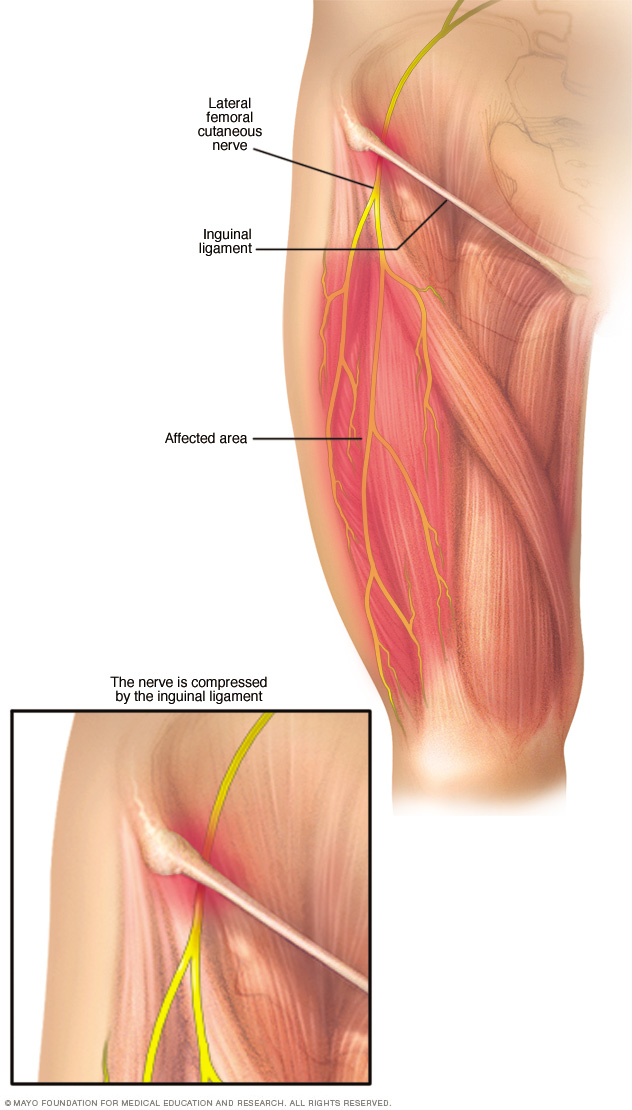 Meralgia Paresthetica Middlesex Health