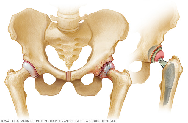 Перелом шейки бедра видео. Artificial Hip.