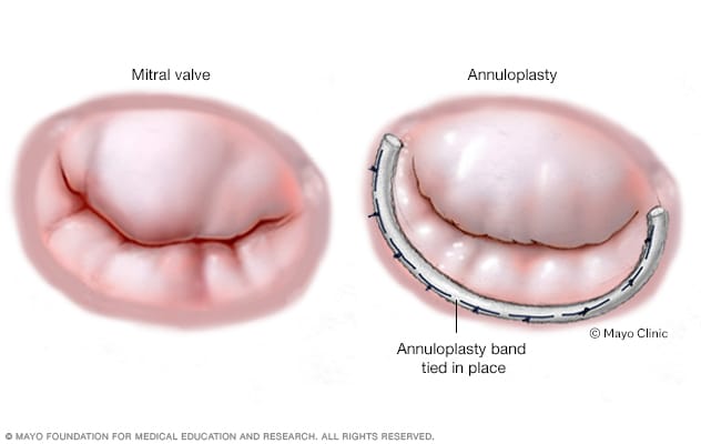 Una anuloplastia