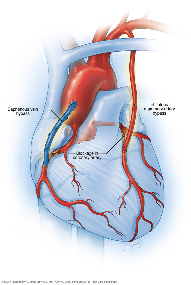 Chest Ports - Alliance Vascular Institute & Vein Treatment Center