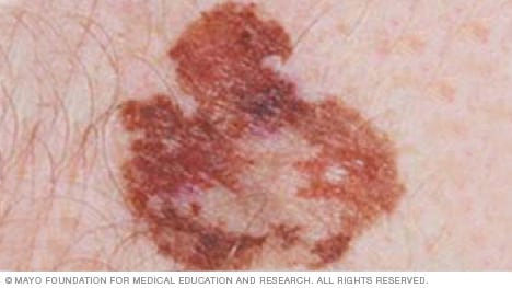 Melanoma con borde irregular