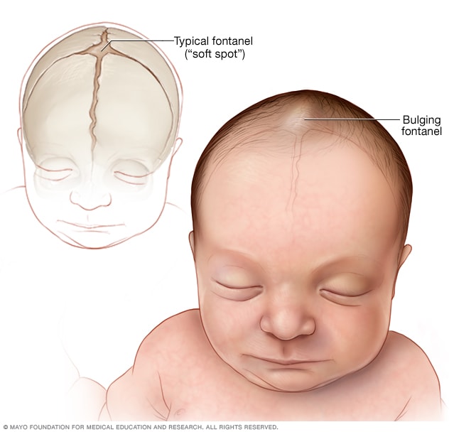 Typical and bulging soft spots, also known as fontanels, of a baby's skull