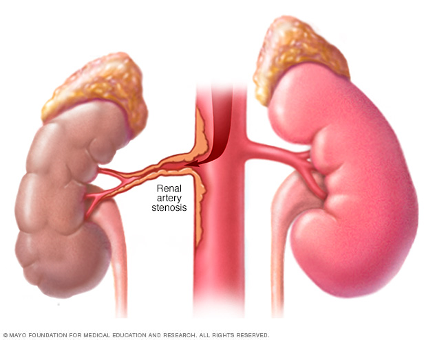 Estenosis de la arteria renal