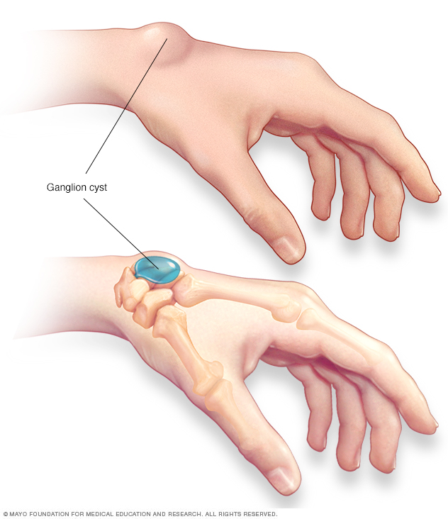 Ganglion cyst // Middlesex Health