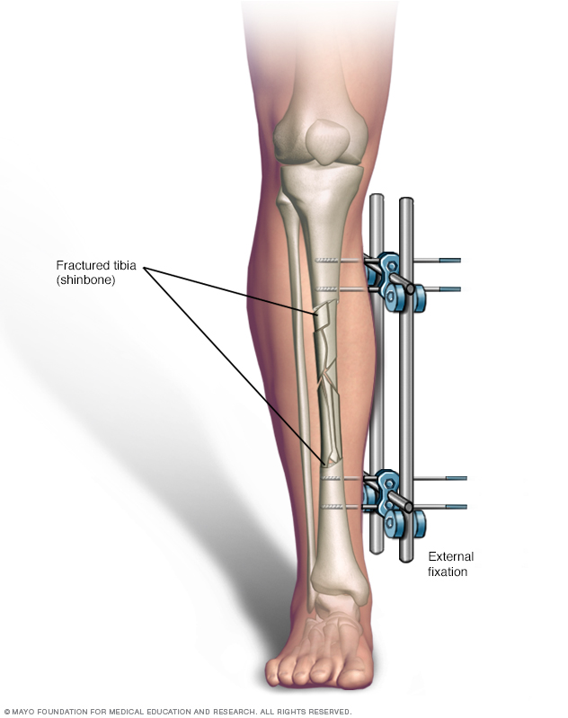 Illustration of broken leg with external fixation 