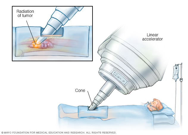 Radioterapia intraoperatoria para un sarcoma de muslo