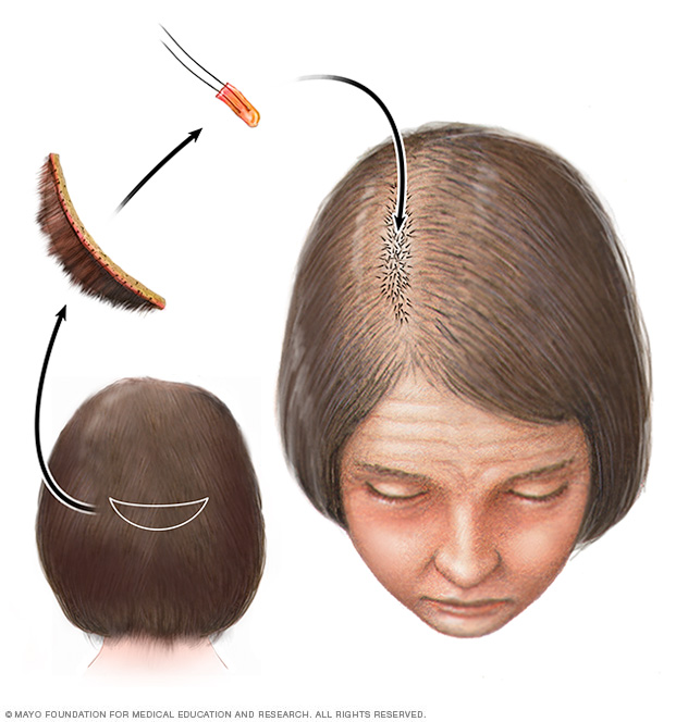 Trasplante capilar para pérdida de cabello hereditaria